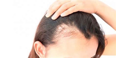 Concerns With Metoprolol Causing Alopecia (Hair Loss).